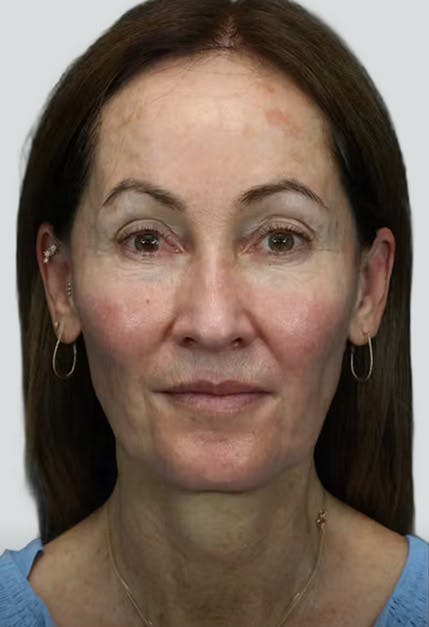 facelift before image