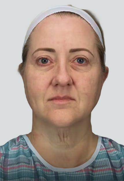rhinoplasty before image