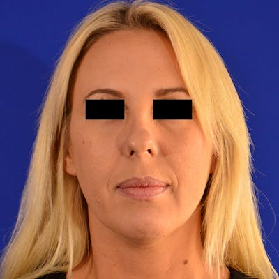 Wide Nose Before & After Gallery - Patient 306616 - Image 1