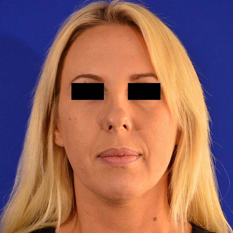 Wide Nose Before & After Gallery - Patient 306616 - Image 1
