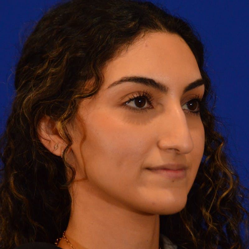 Female Rhinoplasty Before & After Gallery - Patient 224146 - Image 7