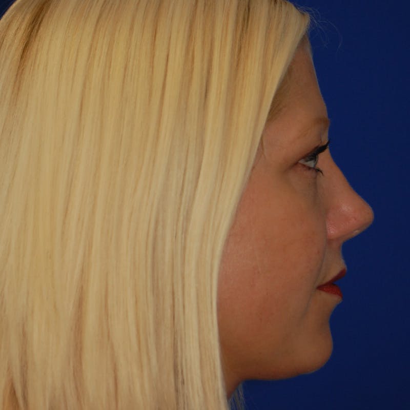 Upper Eyelid Surgery Before & After Gallery - Patient 183887 - Image 9