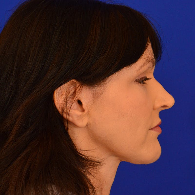 Crooked Nose Before & After Gallery - Patient 158738 - Image 5