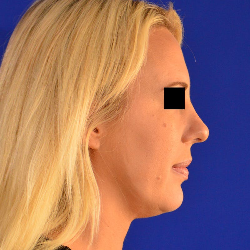 Wide Nose Before & After Gallery - Patient 306616 - Image 5