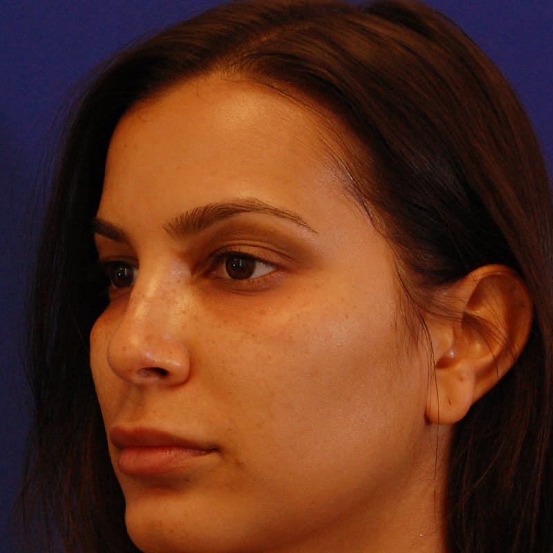Female Rhinoplasty Before & After Gallery - Patient 396658 - Image 10