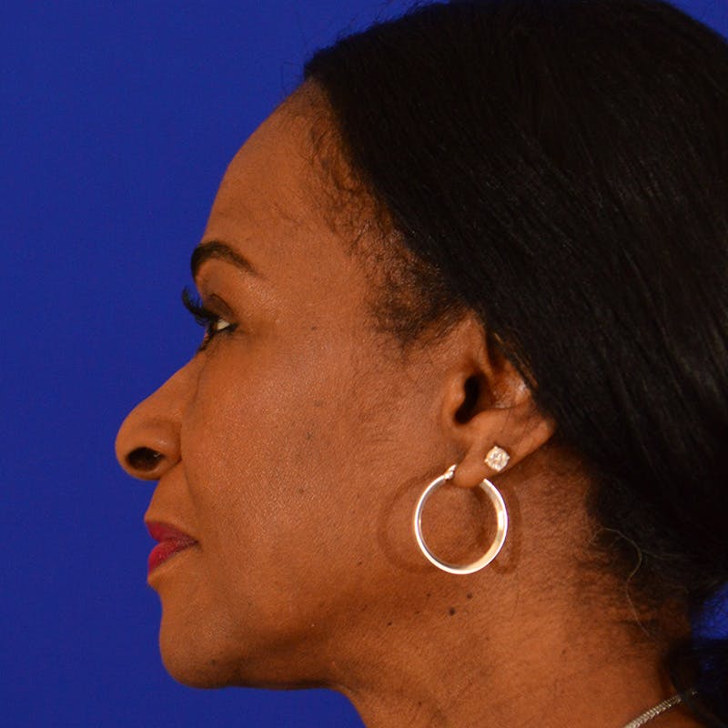 Female Rhinoplasty Before & After Gallery - Patient 363804 - Image 1