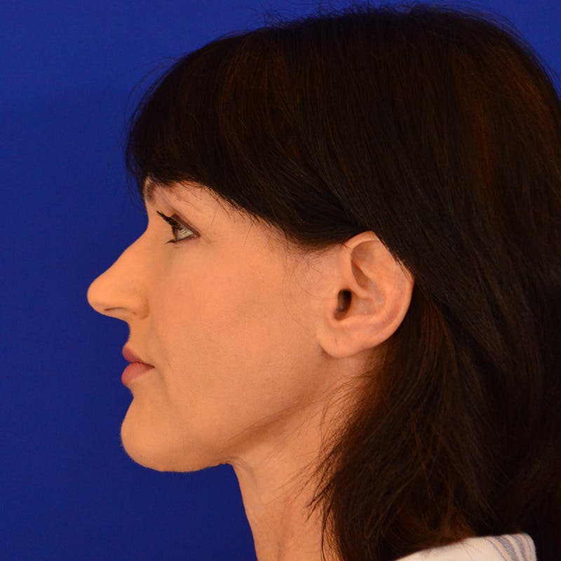 Crooked Nose Before & After Gallery - Patient 158738 - Image 9