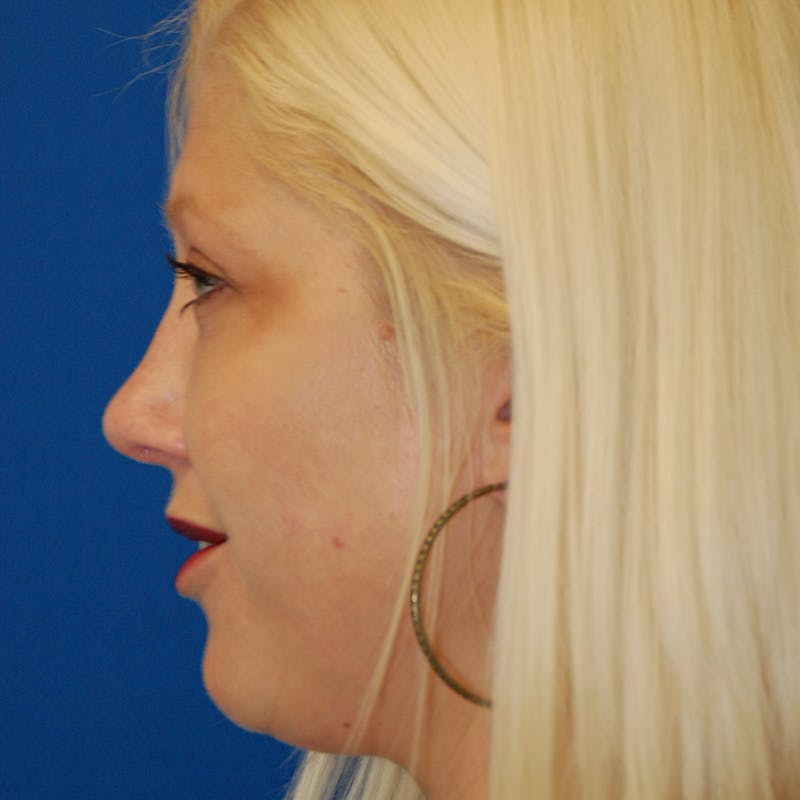 Upper Eyelid Surgery Before & After Gallery - Patient 183887 - Image 6