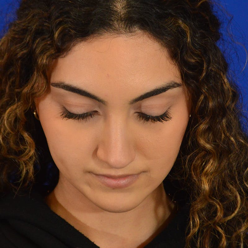 Female Rhinoplasty Before & After Gallery - Patient 224146 - Image 12