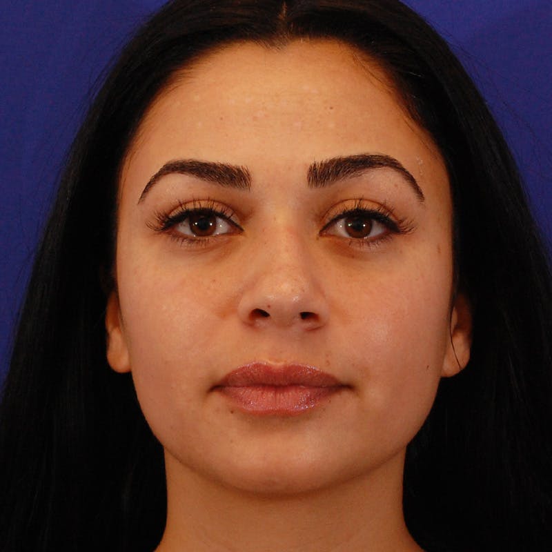Ethnic Rhinoplasty Before & After Gallery - Patient 301212 - Image 3
