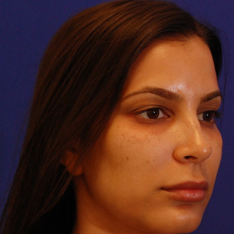 Female Rhinoplasty Before & After Gallery - Patient 396658 - Image 6