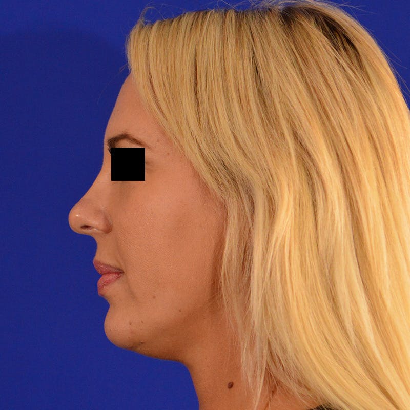 Wide Nose Before & After Gallery - Patient 306616 - Image 9