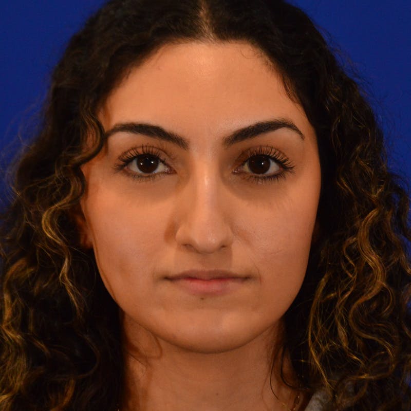 Female Rhinoplasty Before & After Gallery - Patient 224146 - Image 5