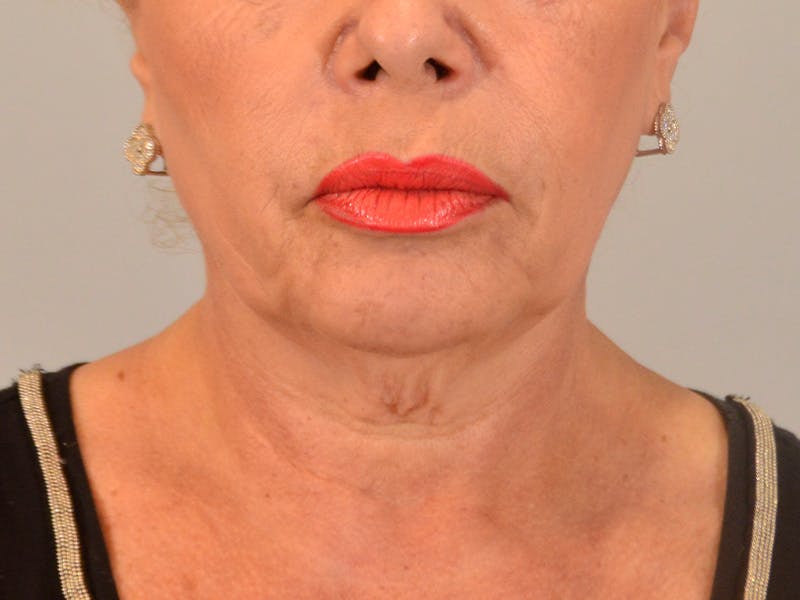Facelift & Necklift Before & After Gallery - Patient 299407 - Image 5