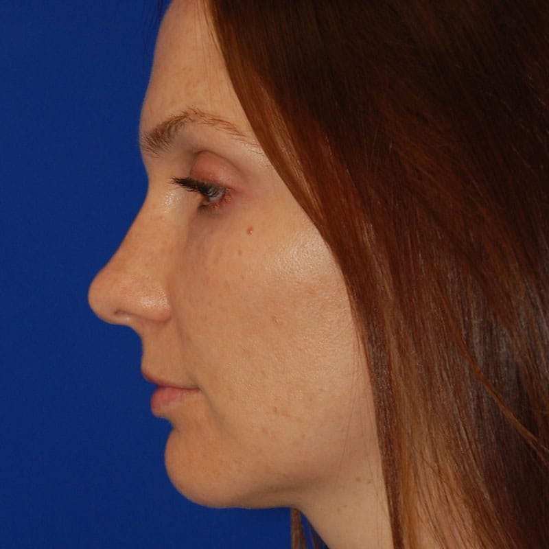 Crooked Nose Before & After Gallery - Patient 803322 - Image 5