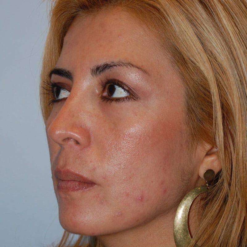 Crooked Nose Before & After Gallery - Patient 303792 - Image 4
