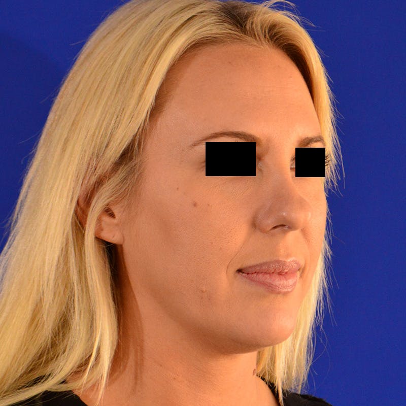 Wide Nose Before & After Gallery - Patient 306616 - Image 3