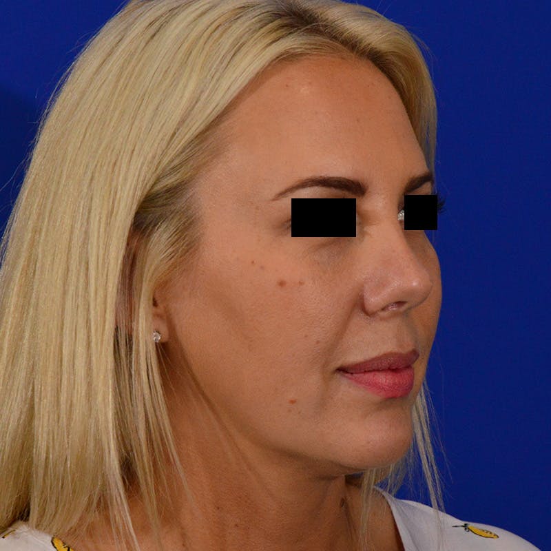 Wide Nose Before & After Gallery - Patient 306616 - Image 4