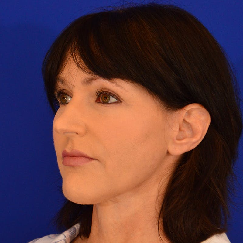 Crooked Nose Before & After Gallery - Patient 158738 - Image 7