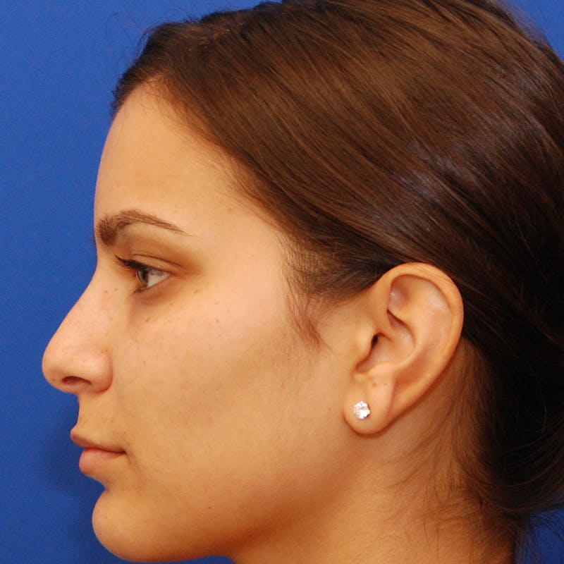 Female Rhinoplasty Before & After Gallery - Patient 396658 - Image 1