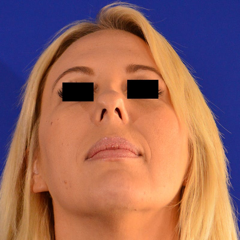Wide Nose Before & After Gallery - Patient 306616 - Image 11