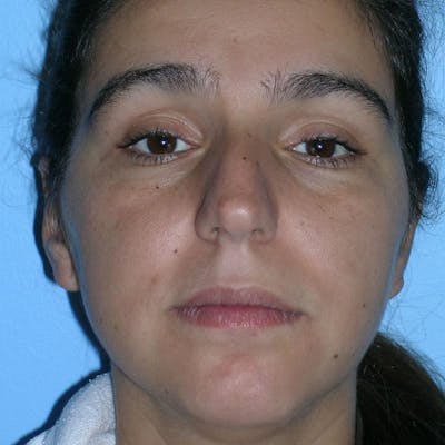 Long Nose Before & After Gallery - Patient 292085 - Image 1