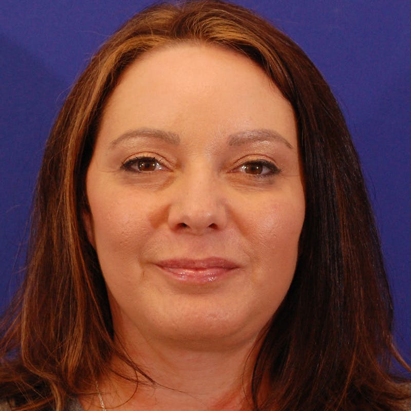 Facelift & Necklift Before & After Gallery - Patient 922406 - Image 2