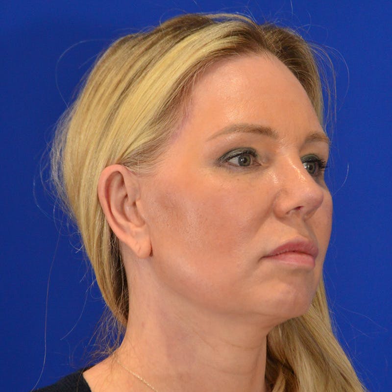 Revision Rhinoplasty Before & After Gallery - Patient 156468 - Image 4