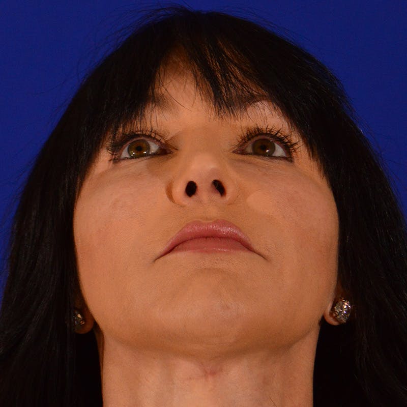 Crooked Nose Before & After Gallery - Patient 158738 - Image 12