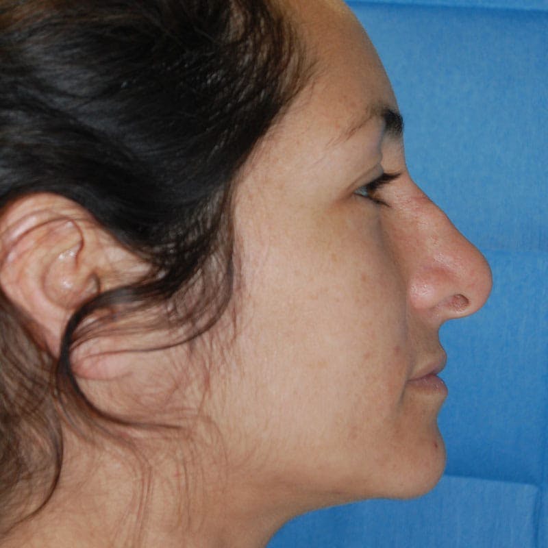 Wide Nose Before & After Gallery - Patient 173051 - Image 5