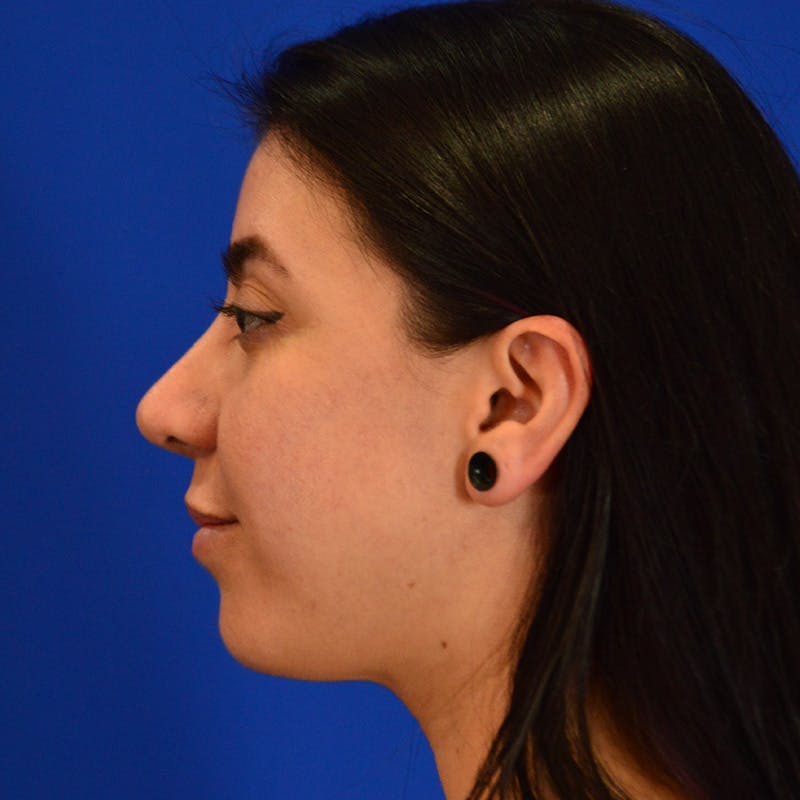 Chin Augmentation Before & After Gallery - Patient 997959 - Image 6