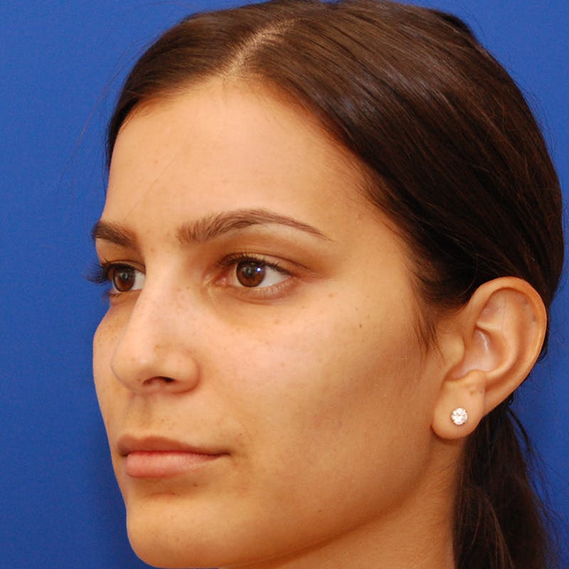 Female Rhinoplasty Before & After Gallery - Patient 396658 - Image 9