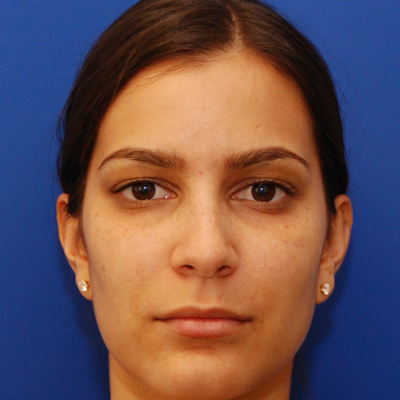 Female Rhinoplasty Before & After Gallery - Patient 396658 - Image 7