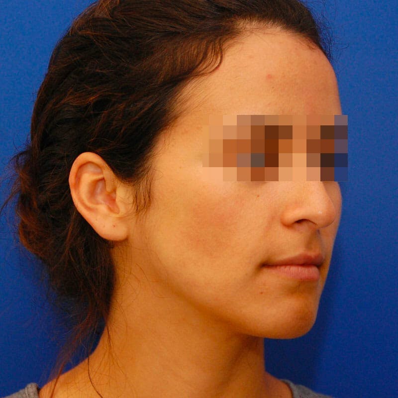 Small Changes Before & After Gallery - Patient 266763 - Image 3