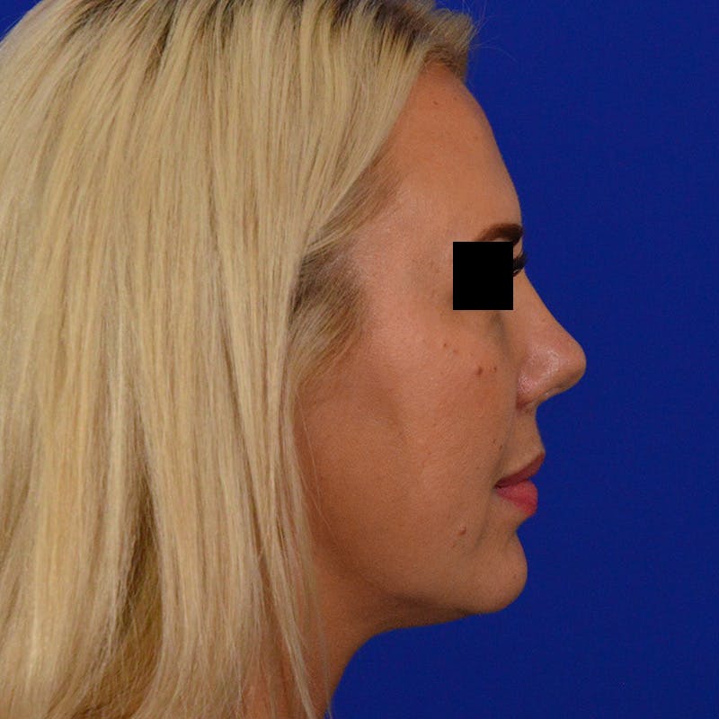 Wide Nose Before & After Gallery - Patient 306616 - Image 6