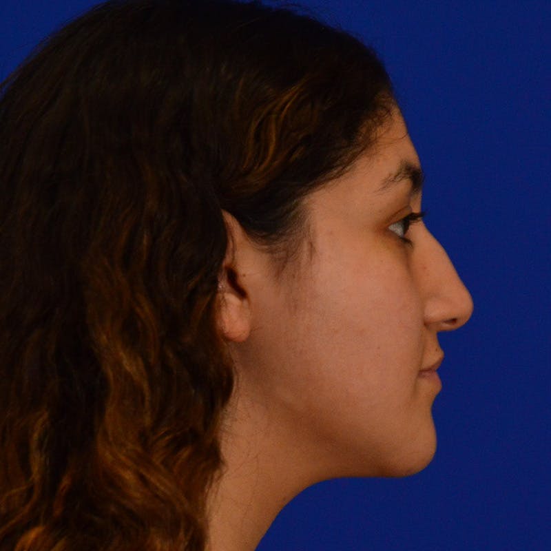 Dorsal Hump Before & After Gallery - Patient 842402 - Image 3