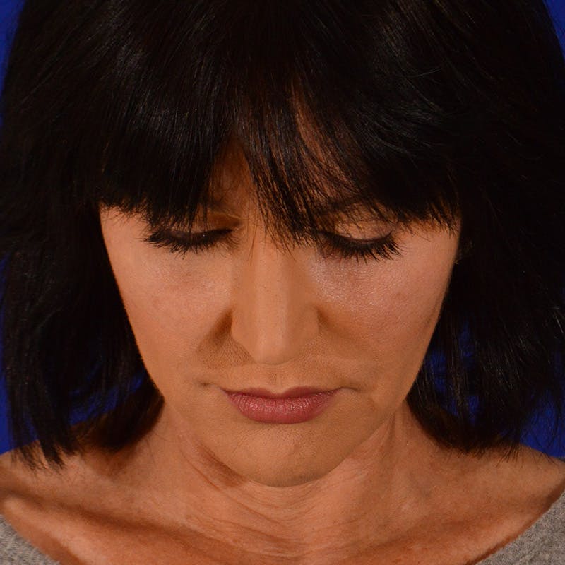 Crooked Nose Before & After Gallery - Patient 158738 - Image 14
