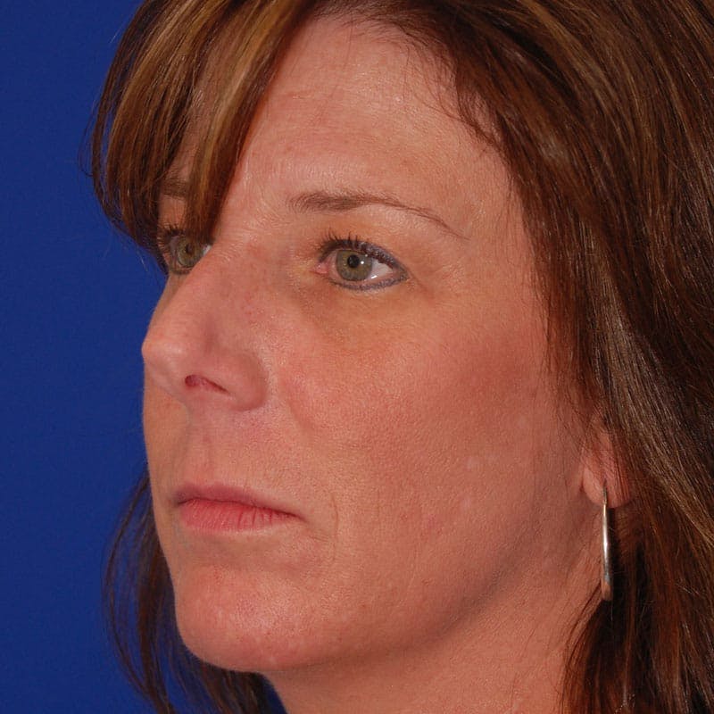 Dorsal Hump Before & After Gallery - Patient 255130 - Image 5
