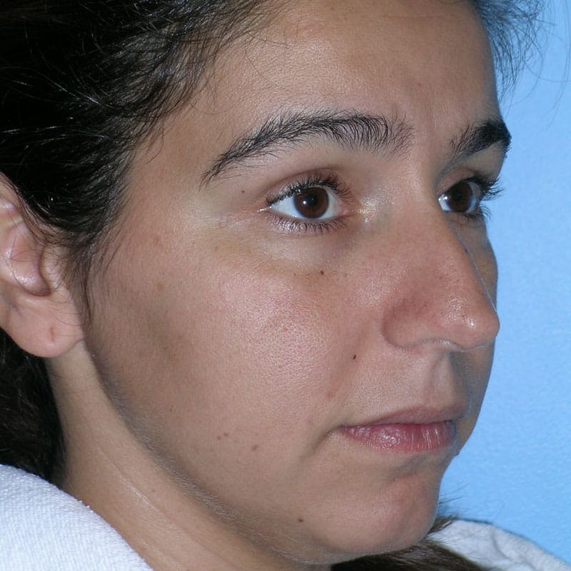 Long Nose Before & After Gallery - Patient 292085 - Image 3