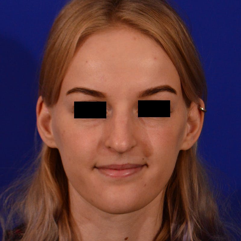 Female Rhinoplasty Before & After Gallery - Patient 124593 - Image 3