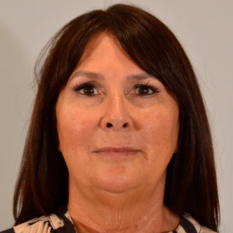 Facelift & Necklift Before & After Gallery - Patient 246000 - Image 1