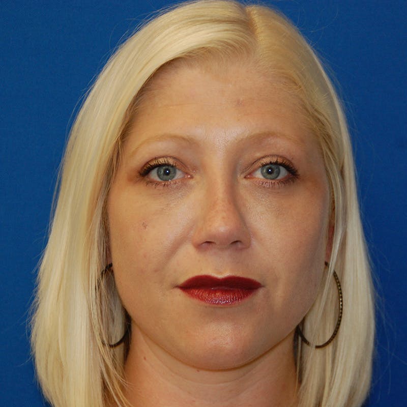 Upper Eyelid Surgery Before & After Gallery - Patient 183887 - Image 2