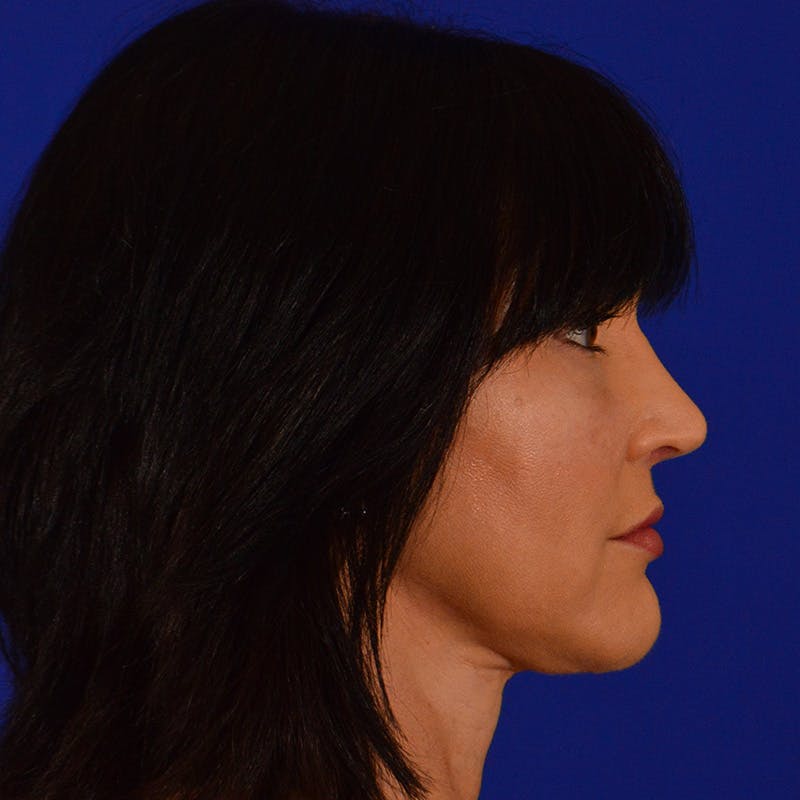 Crooked Nose Before & After Gallery - Patient 158738 - Image 6
