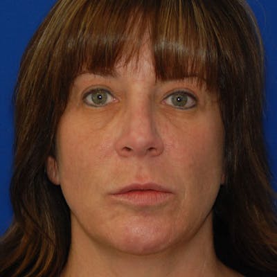 Long Nose Before & After Gallery - Patient 848027 - Image 2