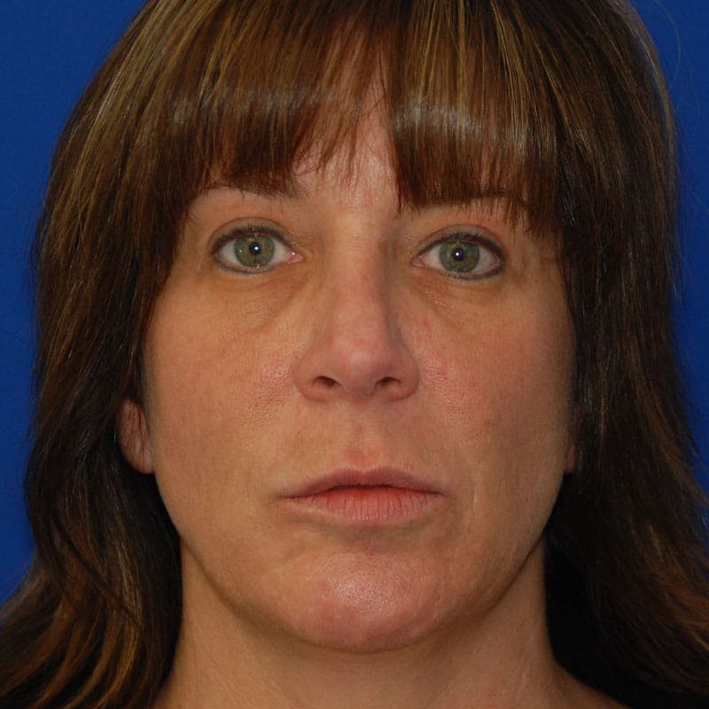 Dorsal Hump Before & After Gallery - Patient 255130 - Image 4