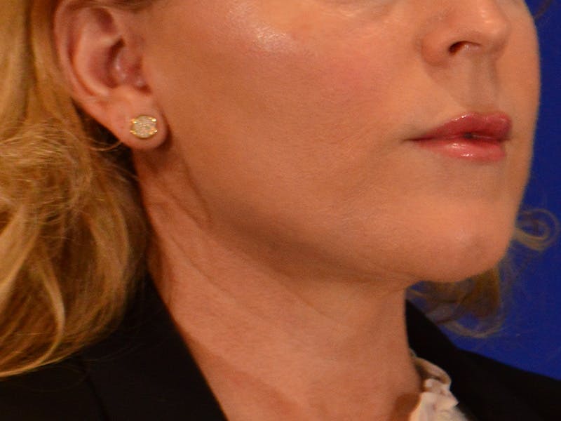 Facelift & Necklift Before & After Gallery - Patient 654569 - Image 4