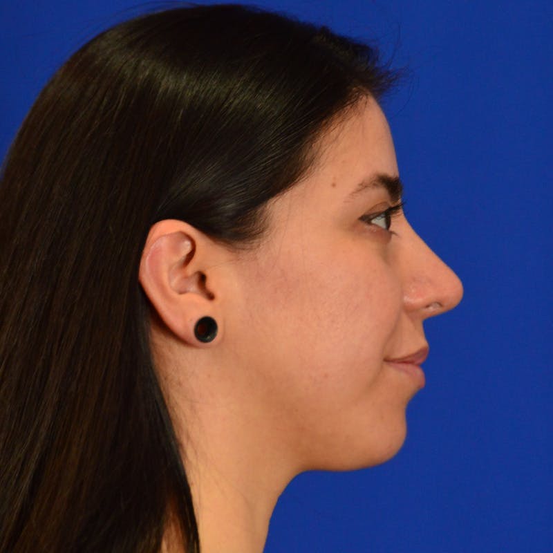 Chin Augmentation Before & After Gallery - Patient 997959 - Image 10