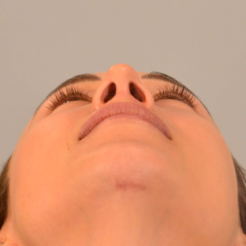 Small Changes Before & After Gallery - Patient 213801 - Image 12