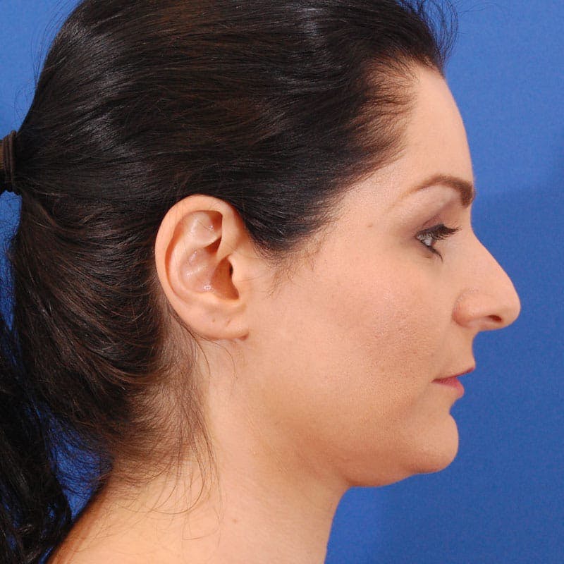 Long Nose Before & After Gallery - Patient 529509 - Image 5