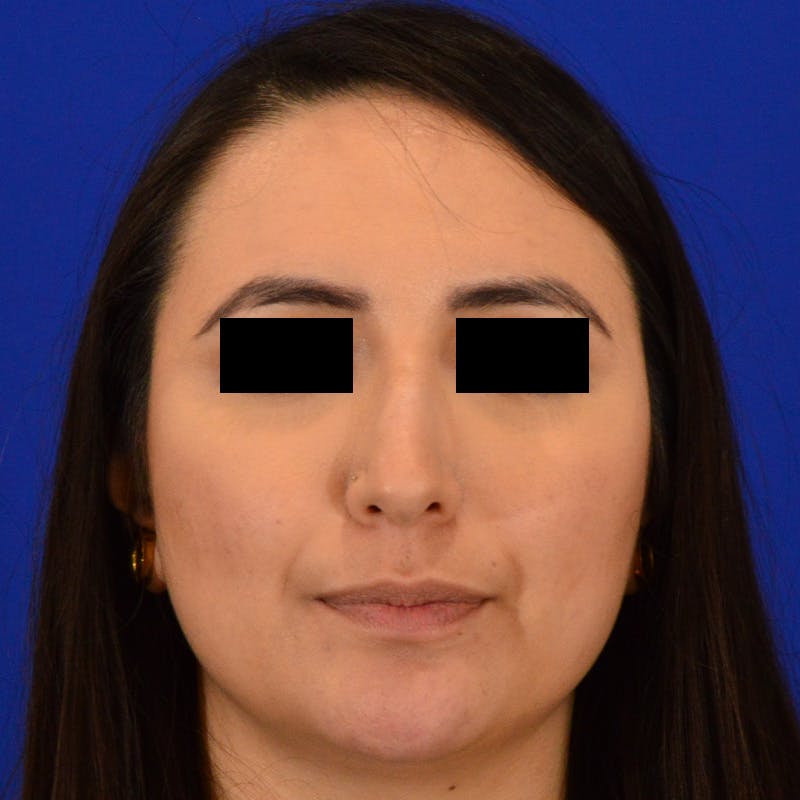Dorsal Hump Before & After Gallery - Patient 750880 - Image 3